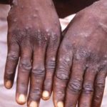 Mpox deaths in Africa surpass 1,000 as well being Officers urge international help