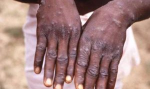 Mpox deaths in Africa surpass 1,000 as well being Officers urge international help
