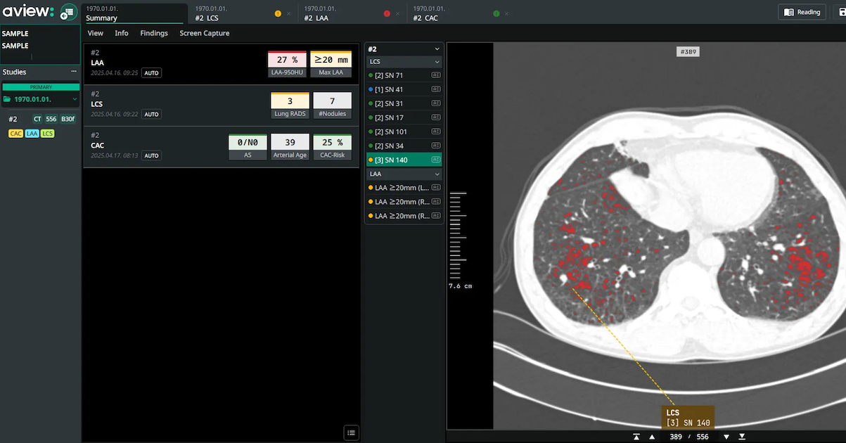 Coreline Gentle’s lung most cancers screening AI added to Bayer’s Calantic platform