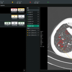 Coreline Comfortable scores imaging AI provide contracts with UK NHS, Boehringer Ingelheim and extra briefs