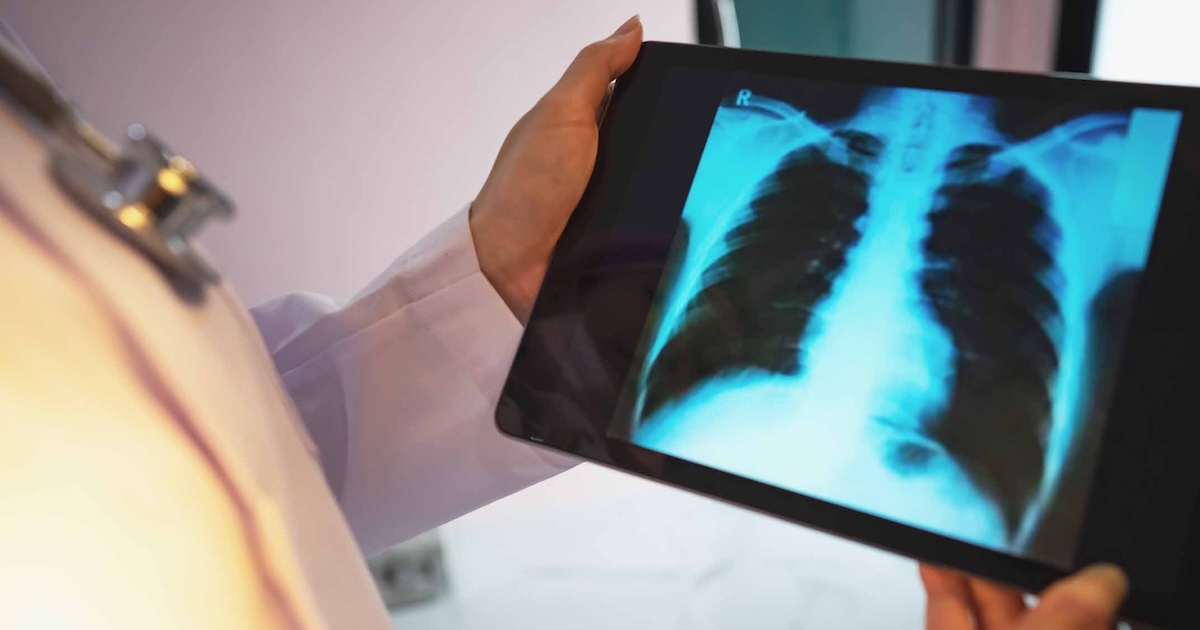 Viz.ai companions with Regeneron, Sanofi to review COPD software